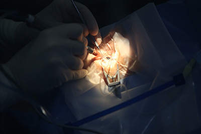 ניתוח קטרקט לחולי קרטוקונוס